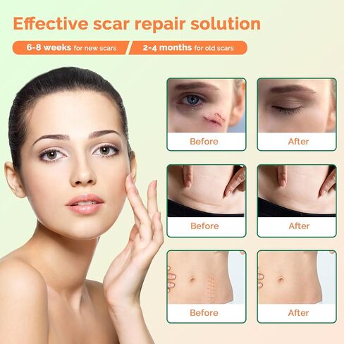 أوراق ندبات السيليكون (1.6 بوصة × 120 بوصة - 3 متر) شريط إزالة الندبات السيليكون القابل لإعادة الاستخدام من الدرجة الطبية الاحترافية للندبات الجراحية، القسم القيصري، الجراحة، الحروق، الجدرة، حب الشباب in Kuwait