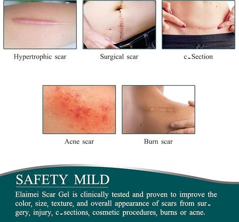 Silicone Scar Sheets(1.57" x 118"Inch - 3M),Scar Away Scar Tape, Scar Strips, Reusable, Professional Scar Removal Sheets for C-Section, Surgery, Burn, Keloid, Acne et, Scar Patch. in Saudi Arabia
