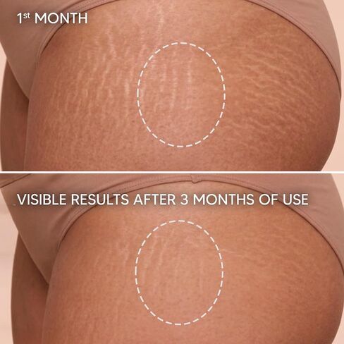 Cicatrissim Stretch Mark Cream for Red and White Striae - Softens Stretch Marks, Evens Skin Tone, and Firms Skin - All Skin Types - 150g in Kuwait