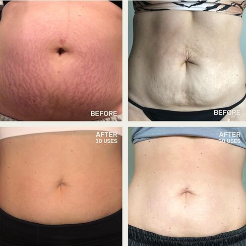 Dermaclara Silicone Patch Stretch Mark Kit - Pregnancy Stretch Mark Prevention, C Section Cover Up Belly Scar, Maternity Skincare, Silicone Gel Sheet, Reusable up to 30 Times - 2 Patches & 1 Cleanser in Kuwait