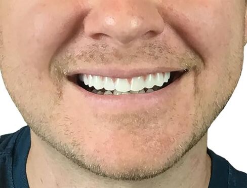 Instant Smile Comfort Fit Flex - Natural Shade - Upper Veneer Cosmetic Teeth in Kuwait
