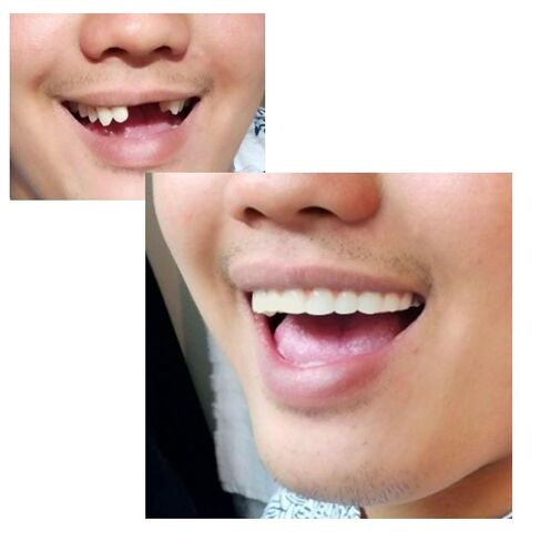 Instant Smile Comfort Fit Flex - Natural Shade - Upper Veneer Cosmetic Teeth in Kuwait