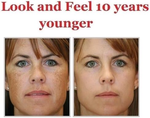 آلة تقشير الجلد - جهاز Appolus Premium Diamond Microdermabrasion للحصول على بشرة متوهجة خالية من العيوب - طرفان ماسيان - 5 رؤوس - مزيل عيوب الرؤوس السوداء - خطوط المسام والتجاعيد المترهل in Kuwait