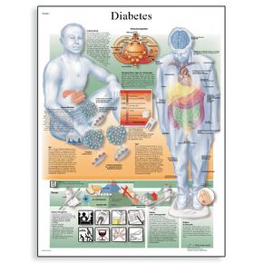 3B Scientific VR1441UU Glossy Paper Diabetes Mellitus Anatomical Chart, Poster Size 20" Width x 26" Height