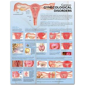 Common Gynecological Disorders Anatomical Chart