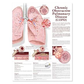 Chronic Obstructive Pulmonary Disease Anatomical Chart