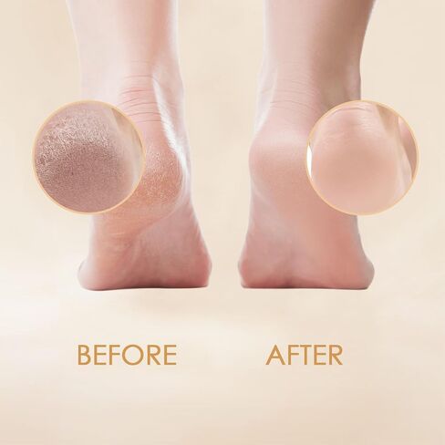 Professional Callus Remover Gel. Extra Strength Formula Removes Tough Callus Instantly. Repairs Dry & Cracked Heels. Unscented - 7 Fl Oz in Saudi Arabia