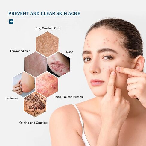 مناديل الأكزيما، مناديل علاج الأكزيما مع دقيق الشوفان، تخفيف الأكزيما سريع المفعول طبيعي بالكامل، يهدئ ويبرد على الفور الحكة والتشقق والتجفيف، مناديل عضوية واقية للبشرة in Kuwait