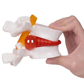 Human Anatomical Lumbar Disc Herniation Model:1.5 Times Life Size Lumbar Disc Teaching Model Tool-for Medical &Teaching & Learning and Scientific Presentations