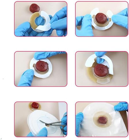 20PCS Ostomy Supplies 4mm Thick Ostomy Barrier Rings in Saudi Arabia