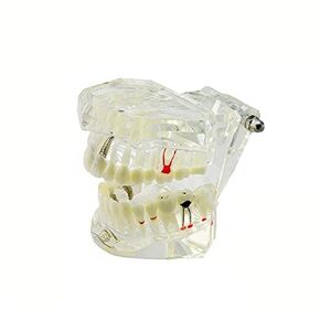 Transparent Dental Implant Disease Teeth Model Dentist Standard Pathological Removable Tooth Teaching Tools
