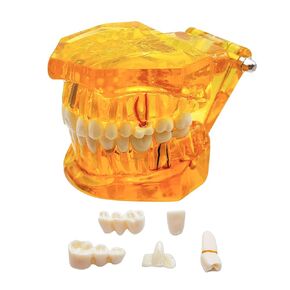 Transparent Disease Teeth Model with Dental Implant Bridge, Dental Teach Crown Bridge Removable Model, Tooth Model for Patient and Dental Student Education. (Transparently)