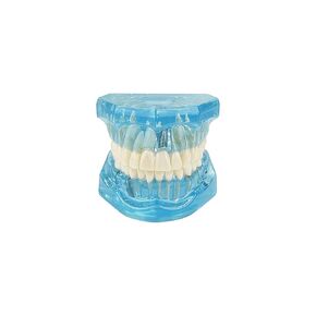 Transparent Disease Teeth Model, YOUYA DENTAL Transparent Dental Implant Teeth Model Dentist Standard Disease Removable Tooth Pathological Teaching Model(Blue)