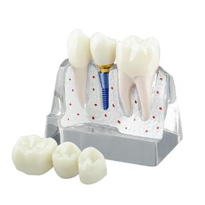 Dental Implant Model for Patient Education, 4 Times Dental Implant, Crown and Bridge Model for Presentation-Transparent
