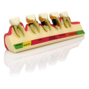 Teeth Periodontal Disease Model Dental Caries Breakdown Display Periodontitis Show Teaching Tooth Model Dentist Odontologia Communication