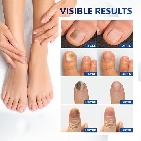 Toenail Fungus Treatment Patches: Nail Fungus Treatment for Toenail - Extra Strength Toe Nail Fungal Patches - Nail Repair Patches - 8-Hour Nighttime Nail Renewal Patches - 21 Patches in Kuwait