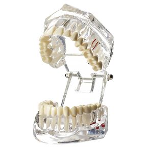 Dental Implant Models Restoration Typodont Teeth Tooth Model Demo Oral Pathology Bridge Teach Study Clear Color M2001