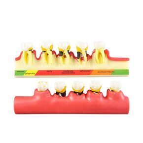 Dental Model Periodontal Classification Model Periodontal Disease Model Dentist-Patient Communication Display Model