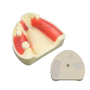 Dental Implant Typodont Practice Teeth Model Lower Jaw Overdenture Soft Gingiva Restoration Demo for Study Teach (M2004)