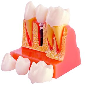 Dental Implant Model with Removable Crown Bridge - 4 Times Enlarged Demonstrative Teeth Model for Education and Study - Ideal for Class Demonstrations and Dental Student Training