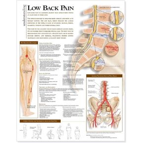 Understanding Low Back Pain Anatomical Chart