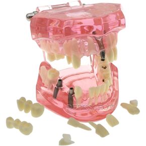Typodont Implant Dental Repair Model Universal Restoration Teeth Oral Prosthesis Pathology Bridge False Tooth Demo for Teach Study M2001 Pink