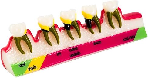 نموذج طب الأسنان Typodont لنموذج دراسة تدريس أمراض اللثة لتعليم المرضى (M8) in Kuwait