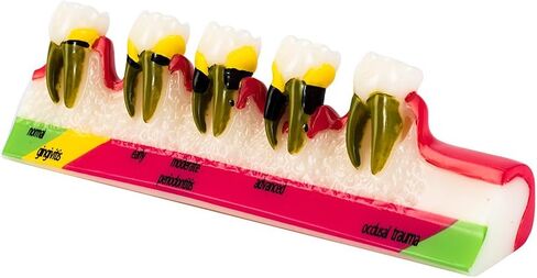 نموذج طب الأسنان Typodont لنموذج دراسة تدريس أمراض اللثة لتعليم المرضى (M8) in Kuwait