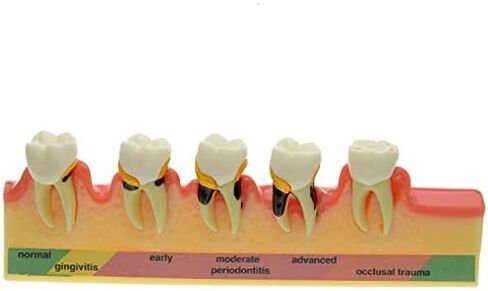نموذج طب الأسنان Typodont لنموذج دراسة تدريس أمراض اللثة لتعليم المرضى (M8) in Kuwait