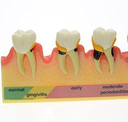 نموذج طب الأسنان Typodont لنموذج دراسة تدريس أمراض اللثة لتعليم المرضى (M8) in Kuwait