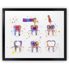 Dignovel Studios 8X10 Unframed Endodontics Therapy Treatment Tooth Watercolor Art Print Root Canal Treatment Dental Clinic Décor Dentist Dentistry Office Medical Wall Décor DN750