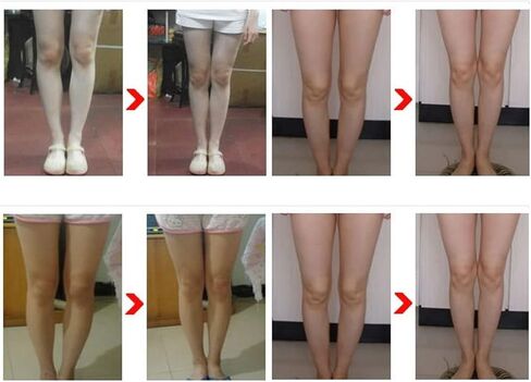 3pcs Leg Correction Belt, Stretchy Shaping Legs Posture Corrector for X Type Legs O Type Legs(XL) in Saudi Arabia