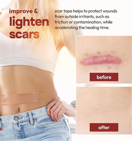 Silicone Scar Tape Reusable Sheets (60" x 1.6") Medical Grade Silicone Scar Sheets for Surgical Scars, Burns, Tummy Tuck, Keloid, C-Section - Cut to Size Scar Treatment in Saudi Arabia