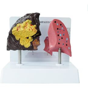 YANHAO Smokers Lung Model + Healthy Lung Model Life Size Human Lung Anatomy Model with Pathological Features and Accurate Anatomy Structure for Emonstrate The Effects of Smoking on Lung Health