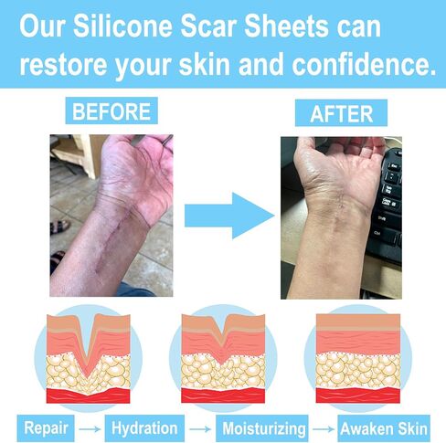 Silicone Scar Sheets (1.6" x 120" Roll-3M), Silicone Scar Tape Roll, Scar Silicone Strips, Tummy Tuck, Keloid, and Surgical Scars - Scar Removing Paste Silicone sheet in Saudi Arabia