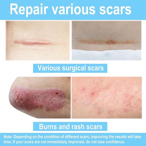 Silicone Scar Sheets (1.6" x 120" Roll-3M), Silicone Scar Tape Roll, Scar Silicone Strips, Tummy Tuck, Keloid, and Surgical Scars - Scar Removing Paste Silicone sheet in Saudi Arabia