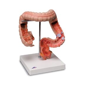 3B Scientific - 1008496 K55 Intestinal Diseases - 3B Smart Anatomy