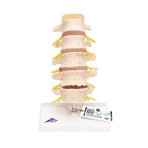 3B Scientific A795 مراحل انحطاط القرص الفقري للفقرات - 3B Smart Anatomy