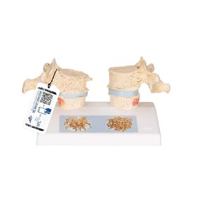 3B Scientific A95 Osteoporosis Model - 3B Smart Anatomy
