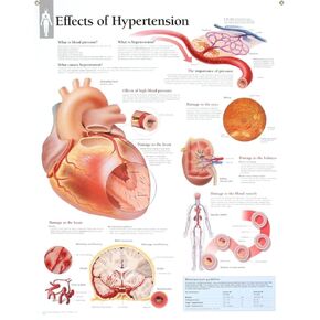 Effects of Hypertension chart: Laminated Wall Chart