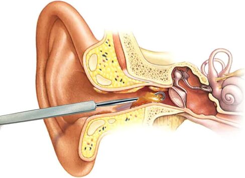 مزيل شمع الأذن الاحترافي من إم جيه دبليو مصنوع من الفولاذ المقاوم للصدأ - منظف كوريت الأذن لإزالة ري الأذن، أداة تنظيف الأذن الصحية القابلة لإعادة الاستخدام للبالغين والأطفال in Kuwait
