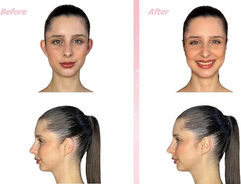 مصحح الأذن التجميلي (30 شريطًا للأذن) - ملصقات أذن سرية لتثبيت الأذنين البارزة. منتج تصحيحي لتثبيت الأذن بدون جراحة. in Saudi Arabia