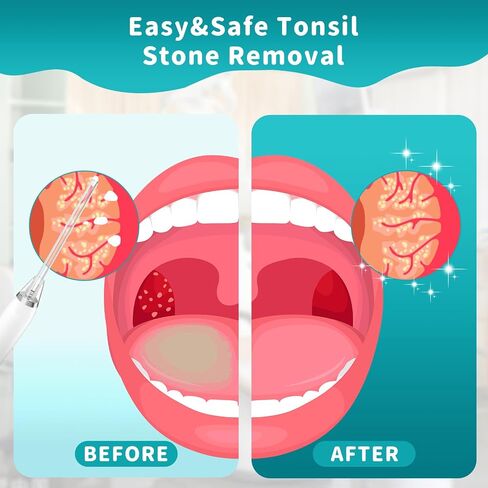 9-PackTonsil Stone Remover Vacuum Tool with Tongue Depressor, Straight & Angled Tubes, Scoop, Magnifying Mirror, Tongue Depressor Tonsil Stones Removal Tool in Saudi Arabia