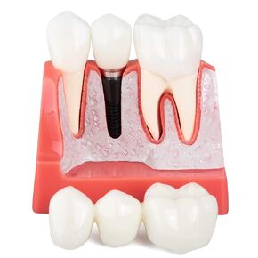LVCHEN Dental Implant Model - 4 Times Crown Bridge Explanation Model Implant Analysis Tooth Model Removable Crown Cross-Section Demonstration for Study and Teaching