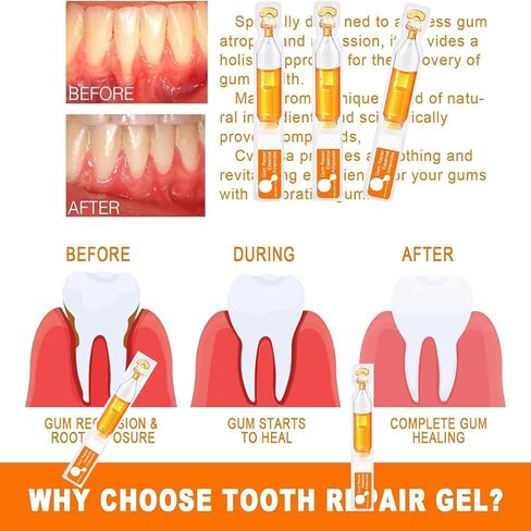 (صندوقان) أمبولات جوهر اللثة، أمبولات انحسار اللثة، إعادة نمو اللثة لانحسار اللثة، علاج اللثة لانحسار اللثة in Kuwait