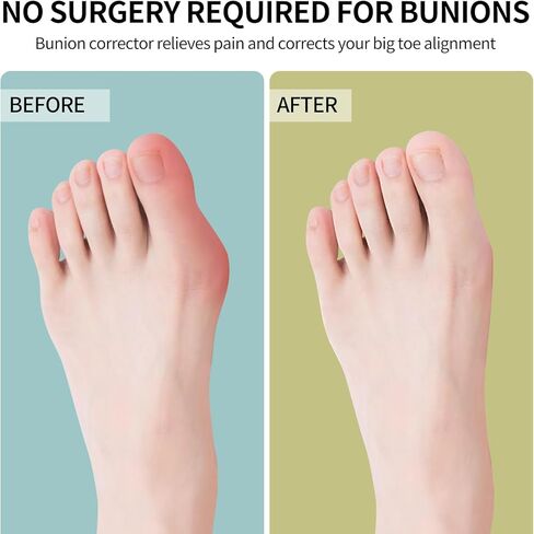 Bunion Corrector for Women & Men ：3-in-1 Adjustable Big Toe Relief Bunion Splints Hammer Toe Straightener，Comfortable, Effective Double Correction，1 set in Saudi Arabia