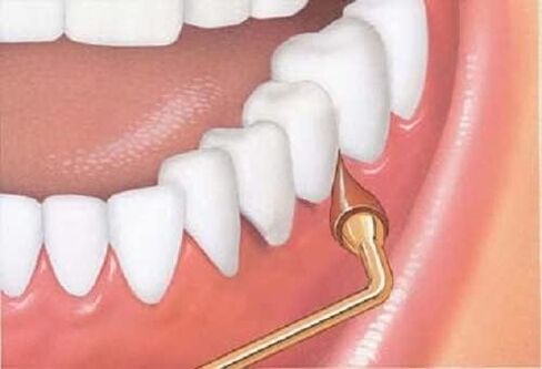 GUM Stimulator Refills - 3 Rubber Tips Included - Compatible with The Stimulator Permanent Handle - Massager, Plaque Removal Health,3ct, 1pk in Kuwait