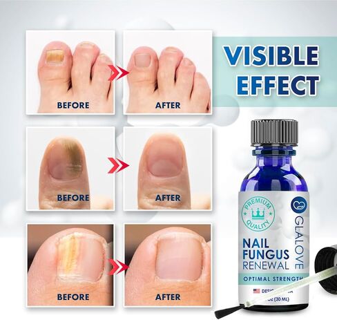 Toenail Fungus Treatment At Home: Nail Fungus Treatment Extra Strength Fast Acting One Week - Safely Repair Renew Damaged And Discolored Toenails - Effectively Improve Athlete's Nail Health in Kuwait