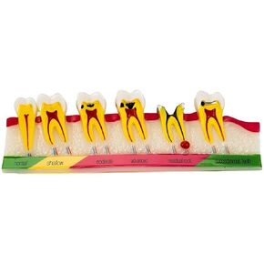 Dental Caries Developing Teeth Model Portable Carious Model for Teaching and Doctor-Patient Communication