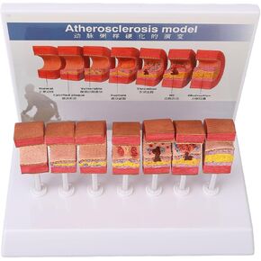 7PCS Artery Anatomy Model with Atherosclerosis Thrombus Vascular Model for Doctors, Educational Tool